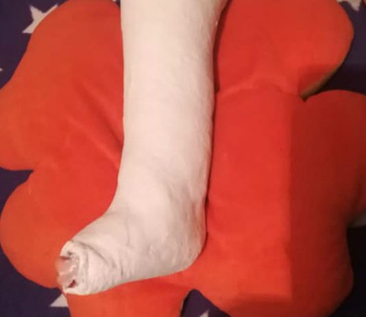 Povestea incredibila a unui copil cu fractura din Ploiesti, nediagnosticat corect