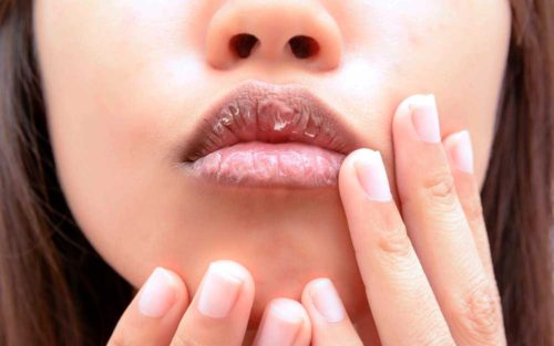 dry-lips-e1511875057766