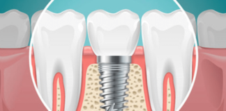 Fast and Fix implant dentar pentru un zâmbet frumos imediat