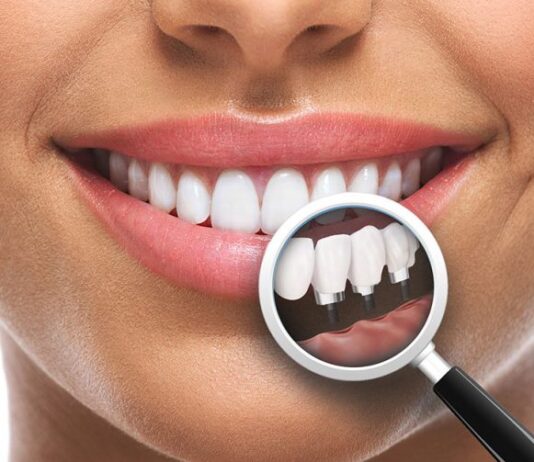 Implantul dentar fast & fixed – principala opțiune pentru înlocuirea dinților lipsă