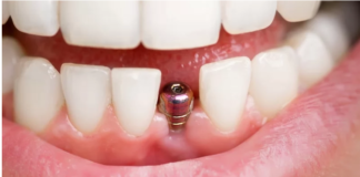 5 motive pentru care să apelezi la un implant de măsea