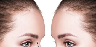 Rinoplastie Bucuresti – ce trebuie sa stii?