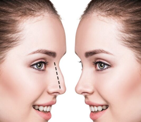 Rinoplastie Bucuresti – ce trebuie sa stii?