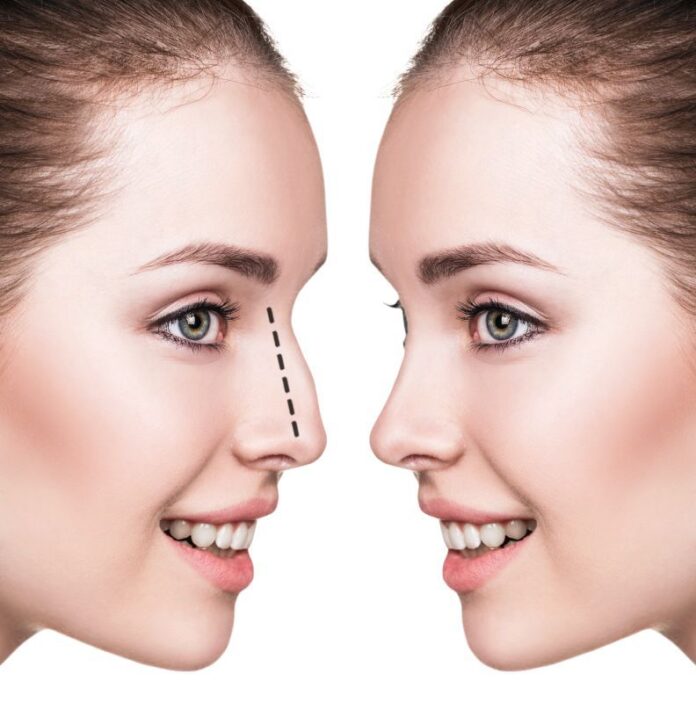 rinoplastie