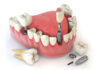 Ce trebuie sa stii despre implantul dentar? Riscuri si durata lucrarilor pe implanturi dentare