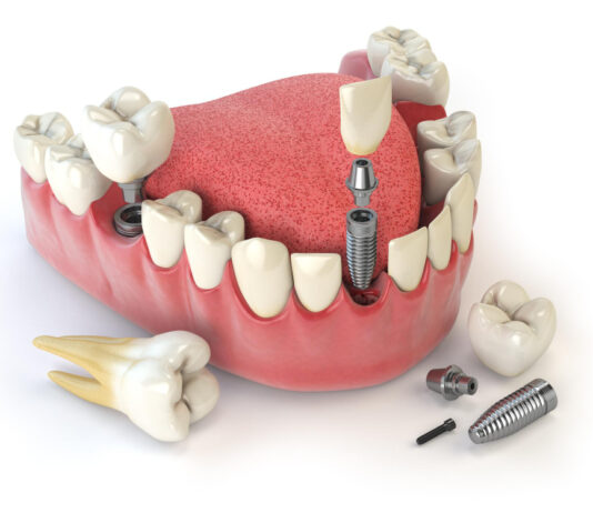 Ce trebuie sa stii despre implantul dentar? Riscuri si durata lucrarilor pe implanturi dentare